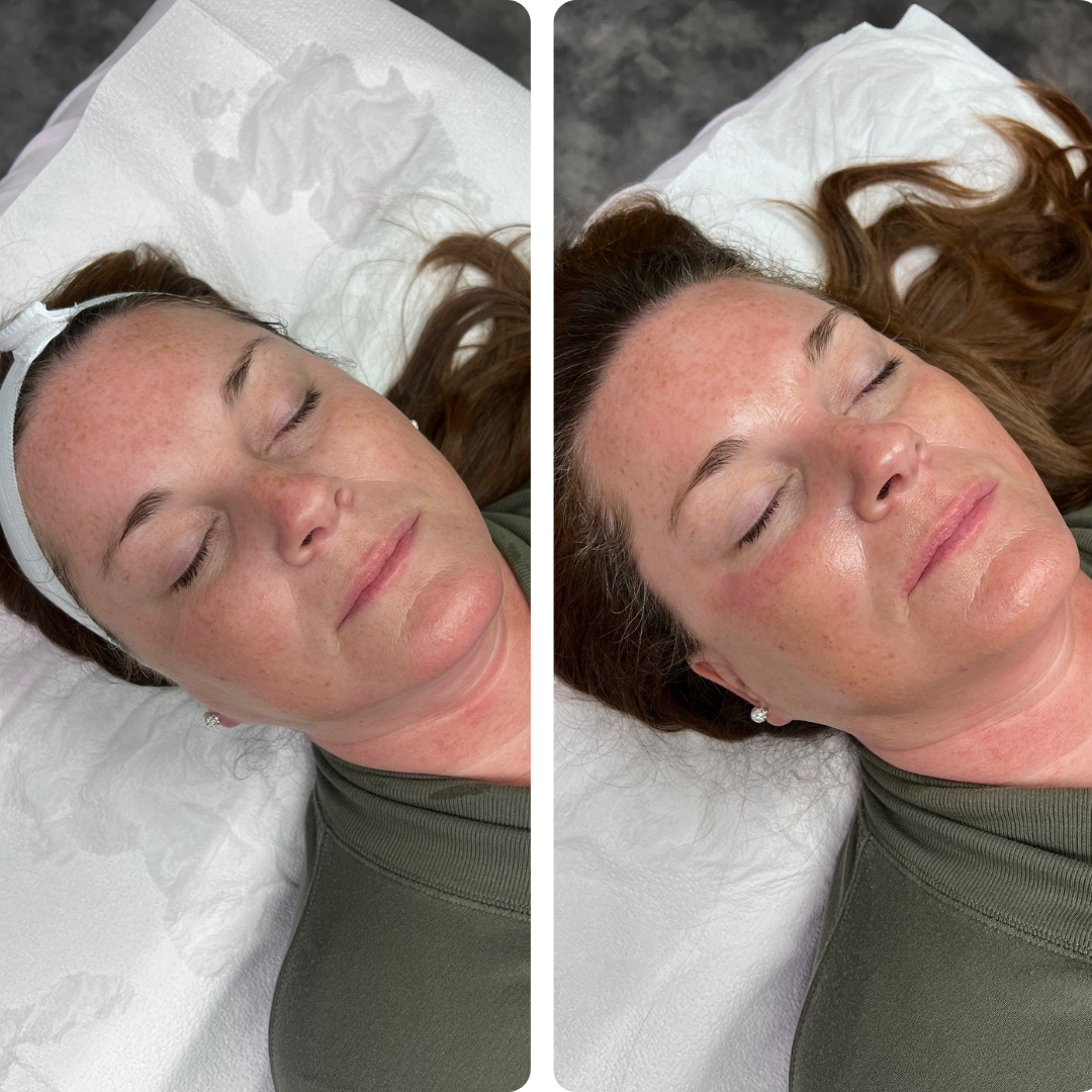 Client's face before and after a Signature HydraFacial, showing a hydrated glow